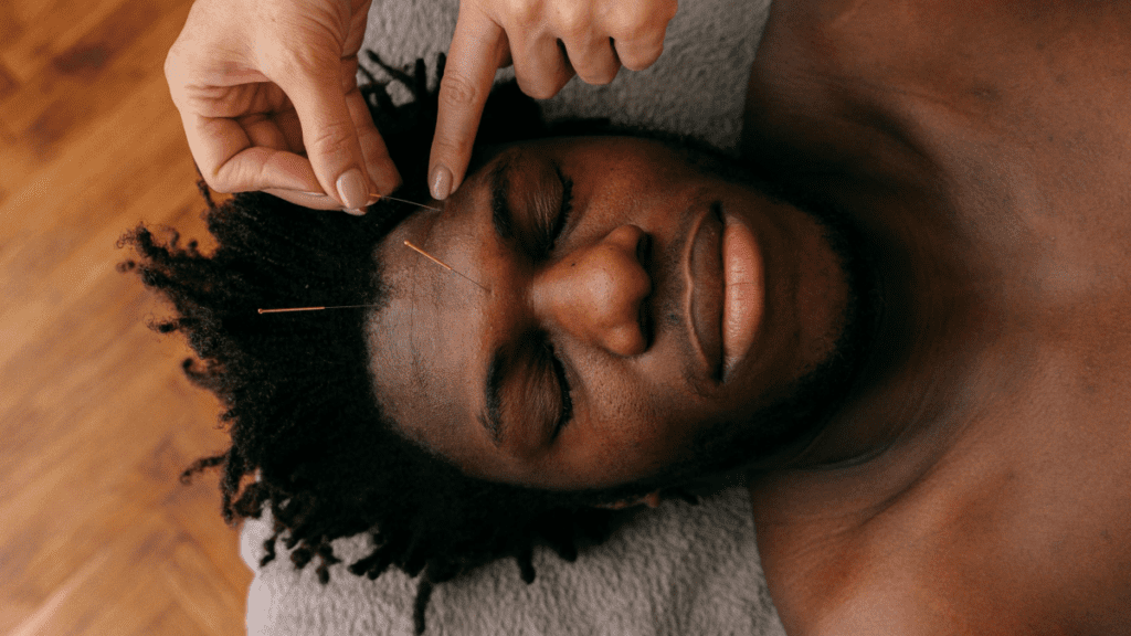 Acupuncture du visage_4 | Treatwell