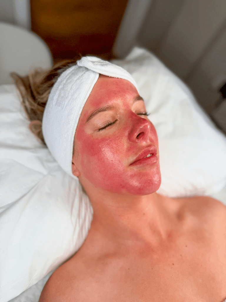 Microneedling, IG @_skinkind | Treatwell