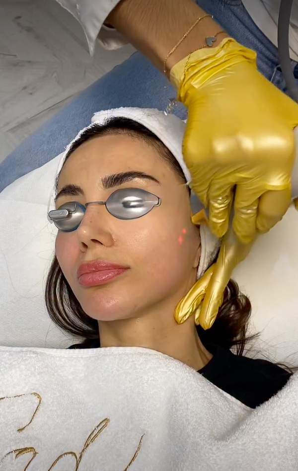 Photoréjuvénation (IPL), IG @sadaf_jaffari | Treatwell